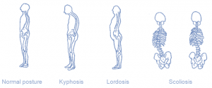 postural deviation